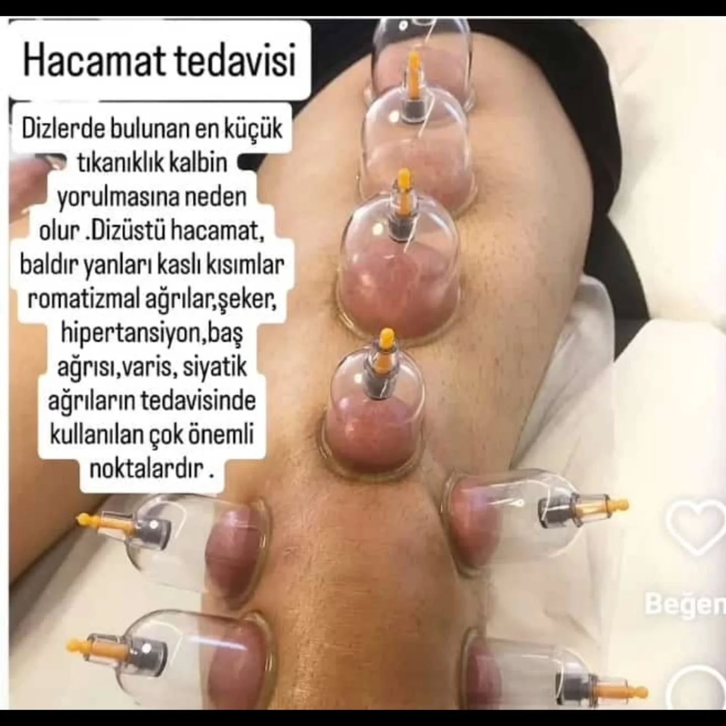Hacamat Tedavisinin Faydaları